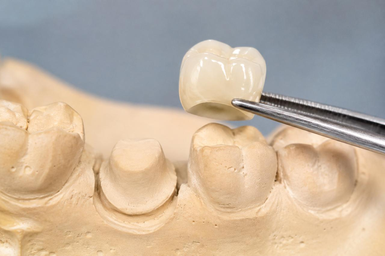 Tooth-coloured dental crown held above a prepared tooth on a dental model